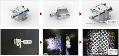 激光焊接在医疗行业的应用——牙套焊接